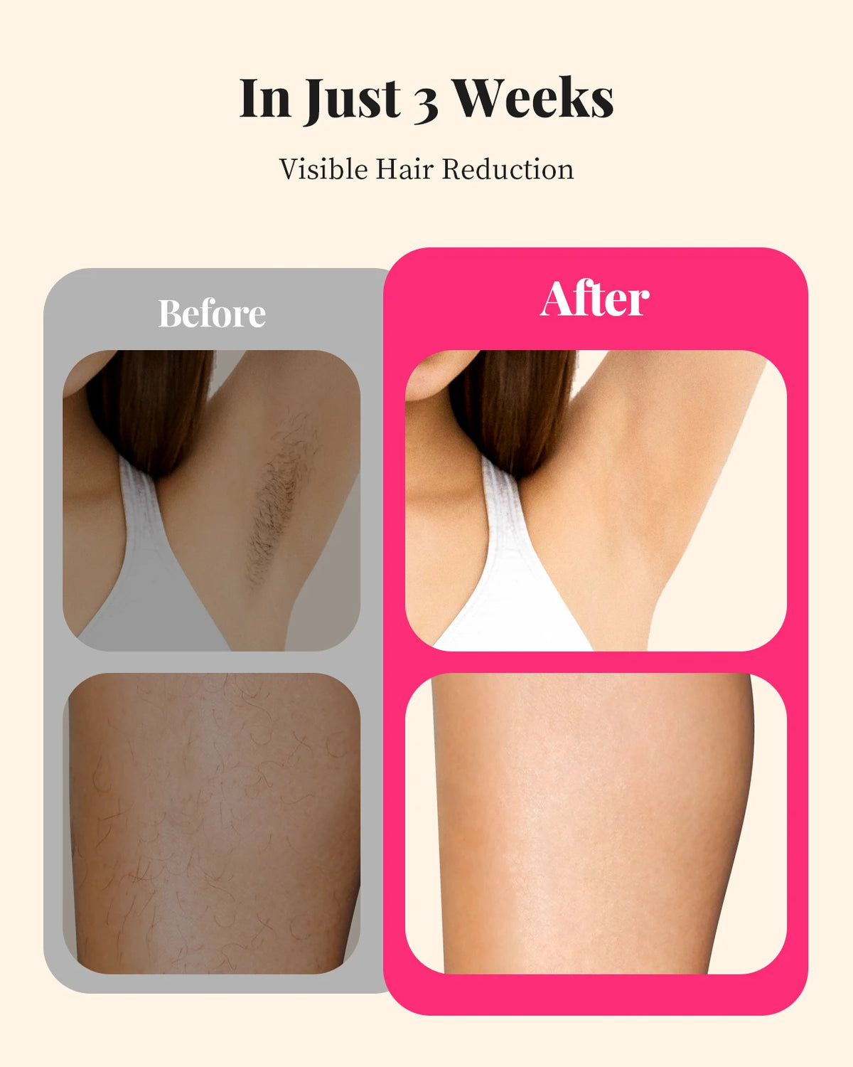 Totmizby IPL Hair Removal For Women Permanent Painless Laser Results